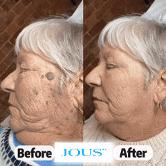 𝐎𝐟𝐟𝐢𝐜𝐢𝐚𝐥 𝐁𝐫𝐚𝐧𝐝 𝐒𝐭𝐨𝐫𝐞|  𝐉𝐎𝑼𝑺® 𝐔𝐩𝐠𝐫𝐚𝐝𝐞𝐝 𝟕-𝐃𝐚𝐲 𝐒𝐤𝐢𝐧 𝐂𝐚𝐫𝐞 𝐑𝐨𝐥𝐥𝐞𝐫 𝐀𝐝𝐯𝐚𝐧𝐜𝐞𝐝 𝐁𝐨𝐭𝐚𝐧𝐢𝐜𝐚𝐥 𝐑𝐨𝐥𝐥𝐞𝐫 𝐟𝐨𝐫 𝐁𝐥𝐞𝐦𝐢𝐬𝐡𝐞𝐬, 𝐒𝐩𝐨𝐭𝐬 & 𝐔𝐧𝐞𝐯𝐞𝐧-𝐋𝐨𝐨𝐤𝐢𝐧𝐠 𝐒𝐤𝐢𝐧